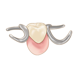 イメージ画像：部分入れ歯