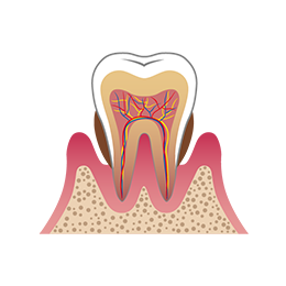 イメージ画像：歯周病中等度