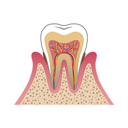 イメージ画像：歯周病軽度
